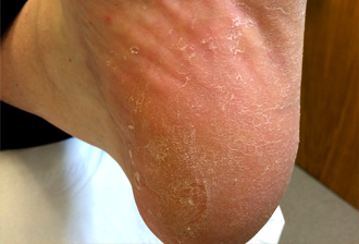 foot skin conditions including fungal infection,athletes foot,verrucae ...